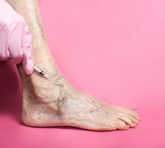 ESCLEROSIS VASCULAR - VARICES